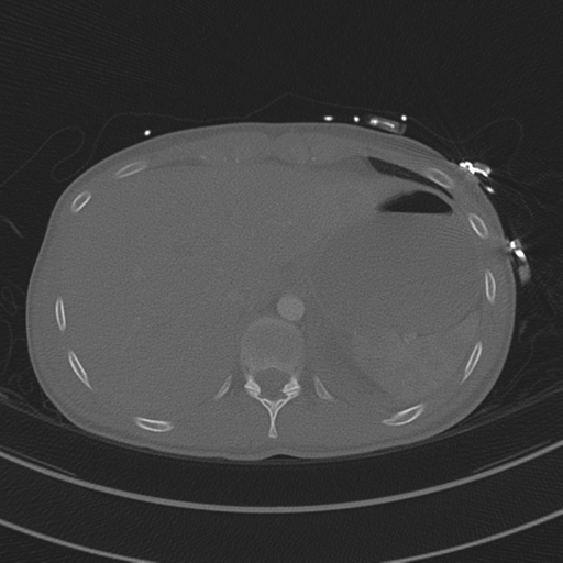 File:Abdominal multi-trauma - devascularised kidney and liver, spleen and pancreatic lacerations (Radiopaedia 34984-36486 I 78).png