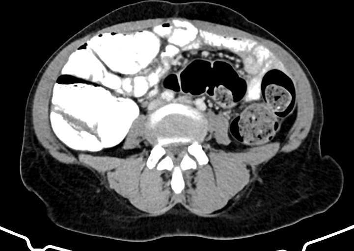Abdominal wall and retroperitoneal tuberculosis (Radiopaedia 88137-104729 Axial C+ portal venous phase 112).jpg