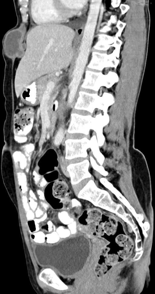 Abdominal wall and retroperitoneal tuberculosis (Radiopaedia 88137-104729 Sagittal C+ portal venous phase 72).jpg
