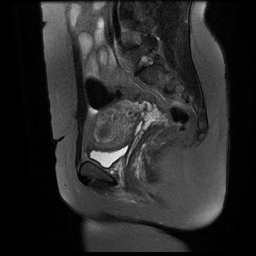 File:Abdominal wall endometriosis (Radiopaedia 83702-98847 Sagittal T2 fat sat 7).jpg