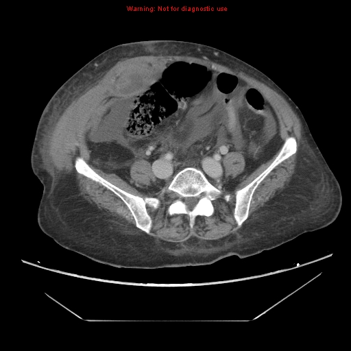 File:Abdominal wall hematoma (Radiopaedia 9427-10112 Axial C+ portal venous phase 74).jpg