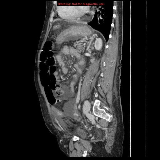 Abdominal wall hematoma (Radiopaedia 9427-10112 Sagittal C+ portal venous phase 39).jpg