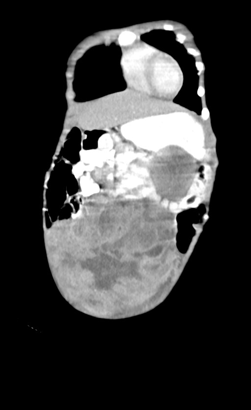 Abdominopelvic rhabdomyosarcoma (Radiopaedia 78356-90984 Coronal C+ portal venous phase 17).jpg