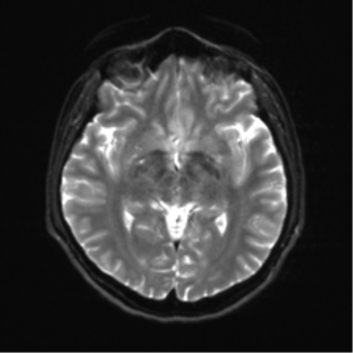 Abducens nerve palsy (Radiopaedia 51069-56648 Axial DWI 12).png