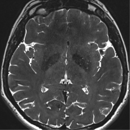 Abducens nerve palsy (Radiopaedia 51069-56648 Axial T2 fat sat 96).png