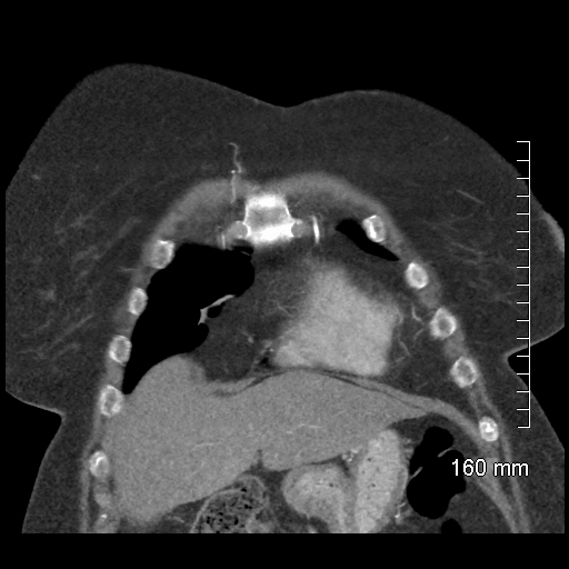 Aberrant right subclavian artery stenosis (Radiopaedia 52656-58670 B 21).jpg