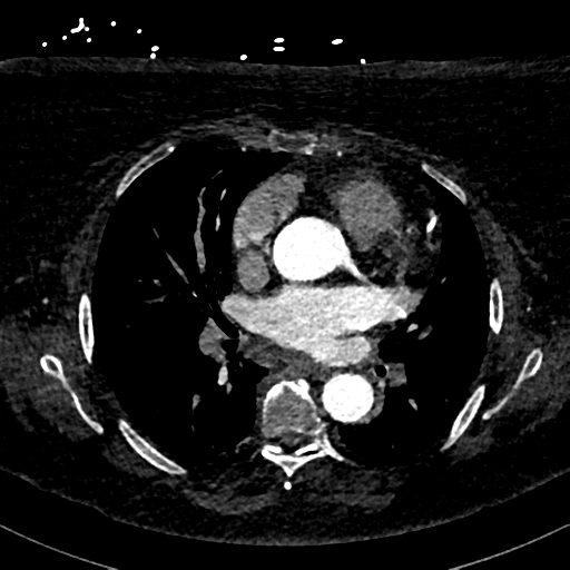File:Aberrant right subclavian artery with Kommerell diverticulum (Radiopaedia 47982-52769 Axial C+ arterial phase 49).png