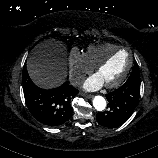 File:Aberrant right subclavian artery with Kommerell diverticulum (Radiopaedia 47982-52769 Axial C+ arterial phase 68).png