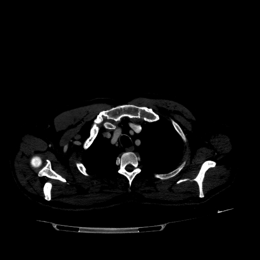 Accesory rib joint (Radiopaedia 71987-82452 Axial bone window 82).jpg