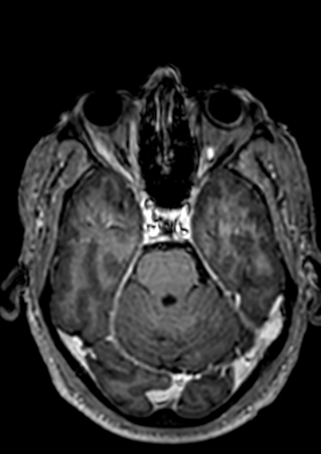 Accessory middle cerebral artery (Radiopaedia 73114-83828 Axial T1 C+ 100).jpg