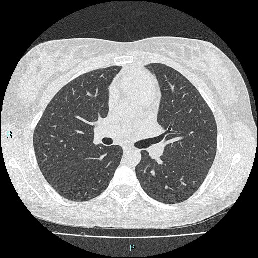 Accidental foreign body aspiration (seamstress needle) (Radiopaedia 77740-89983 Axial lung window 29).jpg