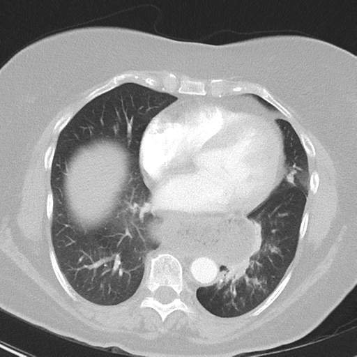 File:Achalasia (Radiopaedia 47147-51685 Axial lung window 32).png