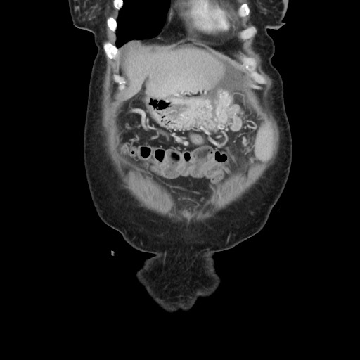 Acinar cell carcinoma of the pancreas (Radiopaedia 75442-86669 Coronal C+ portal venous phase 21).jpg