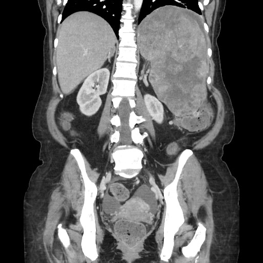 Acinar cell carcinoma of the pancreas (Radiopaedia 75442-86669 Coronal C+ portal venous phase 85).jpg