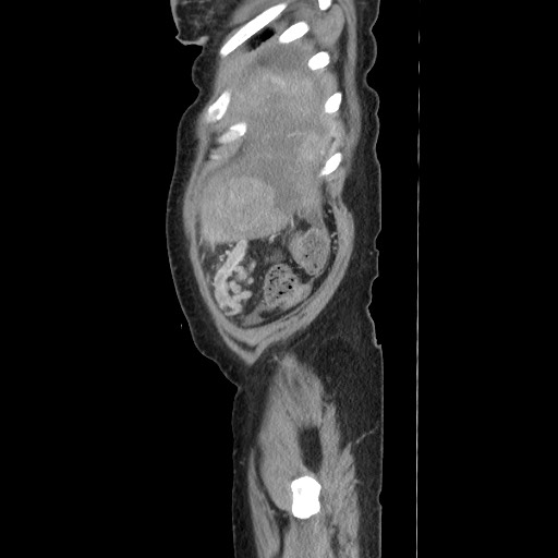 Acinar cell carcinoma of the pancreas (Radiopaedia 75442-86669 Sagittal C+ portal venous phase 173).jpg