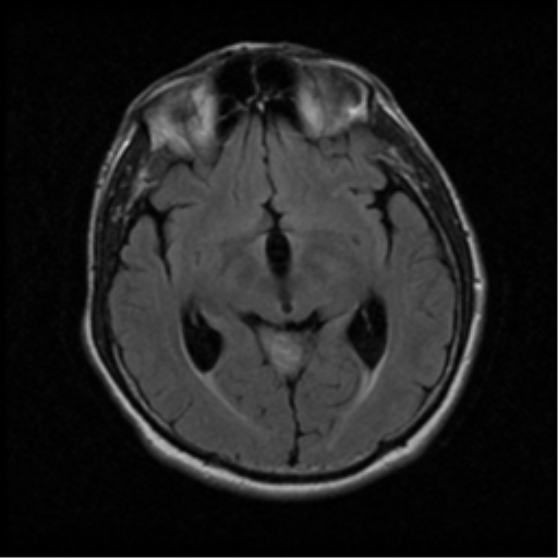 File:Acoustic schwannoma (Radiopaedia 39170-41387 Axial FLAIR 10).png
