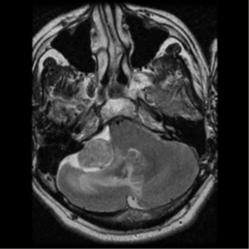 File:Acoustic schwannoma (Radiopaedia 39170-41387 Axial T2 7).png