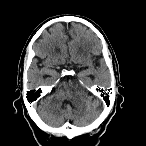 File:Acoustic schwannoma (Radiopaedia 55729-62280 Axial non-contrast 12).png