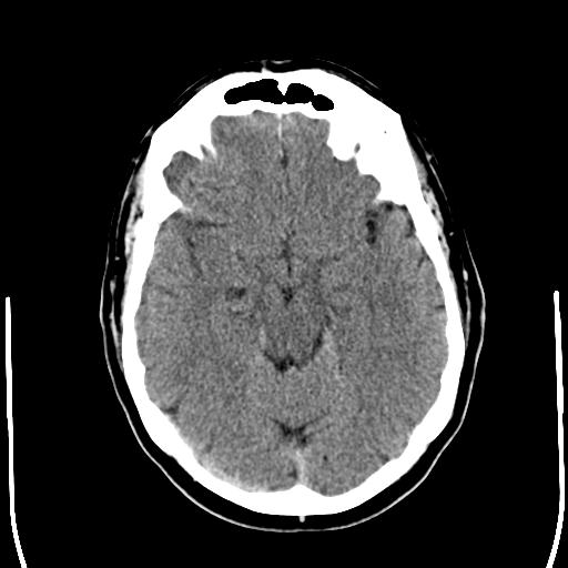 File:Acoustic schwannoma - cystic (Radiopaedia 29487-29980 AXIAL THICK non-contrast 11).jpg