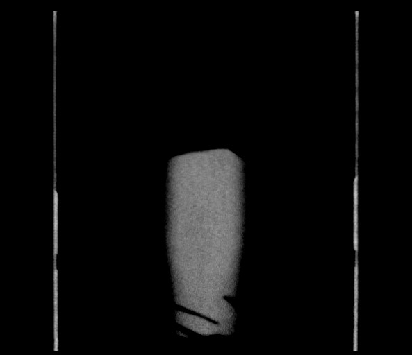 Acromioclavicular joint cyst (Radiopaedia 58455-65610 Coronal C+ arterial phase 153).jpg