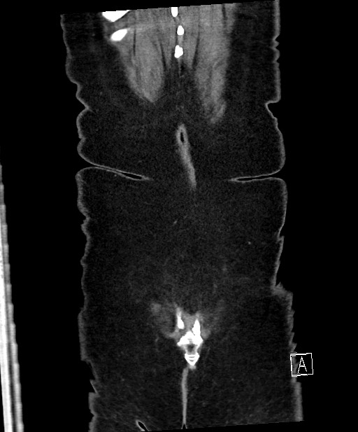 Active Crohn disease (Radiopaedia 59394-66750 Coronal C+ portal venous phase 67).jpg