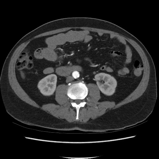 Active colonic bleed on CT (Radiopaedia 49765-55025 Axial C+ arterial phase 42).jpg