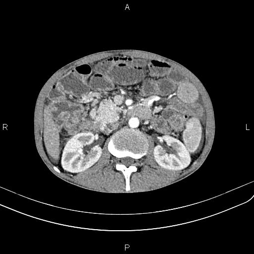 Active crohn disease (Radiopaedia 87133-103397 Axial C+ arterial phase 45).jpg