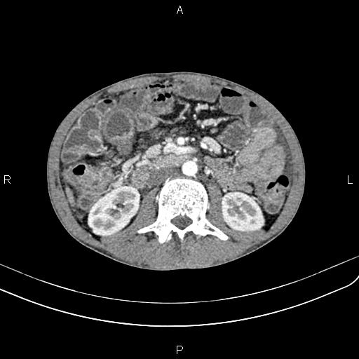 Active crohn disease (Radiopaedia 87133-103397 Axial C+ arterial phase 50).jpg