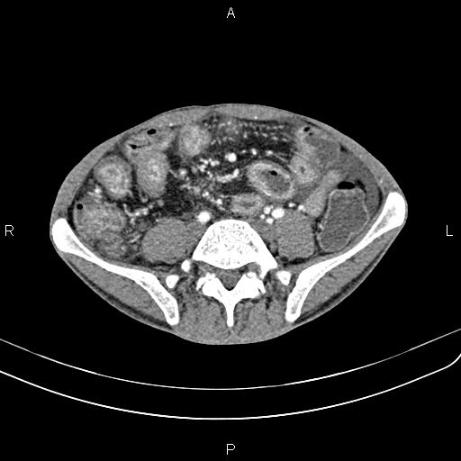 File:Active crohn disease (Radiopaedia 87133-103397 Axial C+ arterial phase 69).jpg