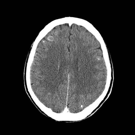 File:Active neurocysticercosis before and after therapy (Radiopaedia 71710-82100 Axial C+ delayed 62).jpg