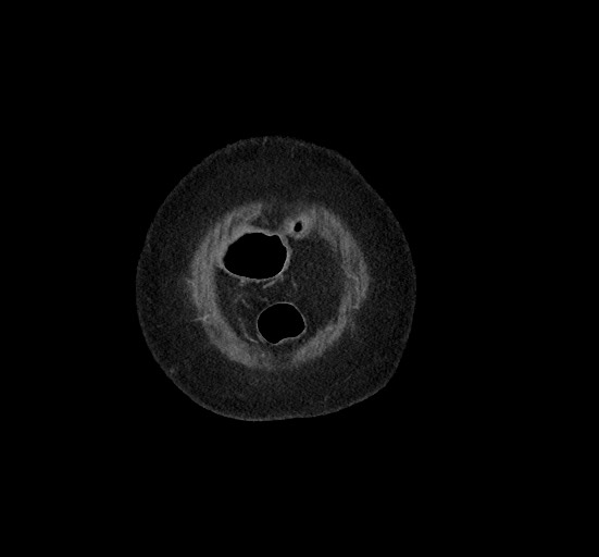 Active renal extravasation with large subcapsular and retroperitoneal hemorrhage (Radiopaedia 60975-68796 Coronal C+ portal venous phase 16).jpg