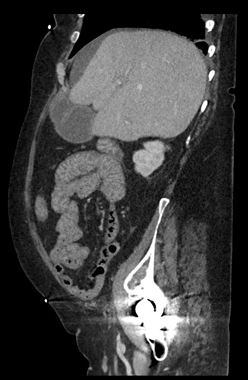 Active renal extravasation with large subcapsular and retroperitoneal hemorrhage (Radiopaedia 60975-68796 Sagittal C+ portal venous phase 162).jpg