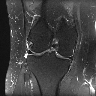 File:Acute-on-chronic transient lateral patellar dislocation with trochlear dysplasia (Radiopaedia 84099-99349 Coronal PD fat sat 18).jpg