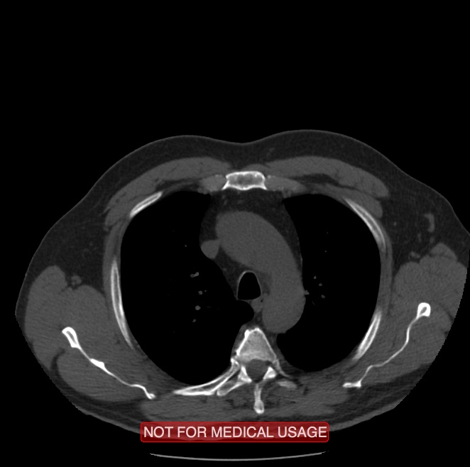 Acute aortic dissection - Stanford type A (Radiopaedia 40661-43285 Axial non-contrast 6).jpg