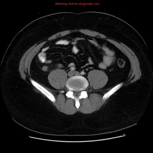 File:Acute appendicitis (Radiopaedia 12326-12607 Axial C+ portal venous phase 20).jpg