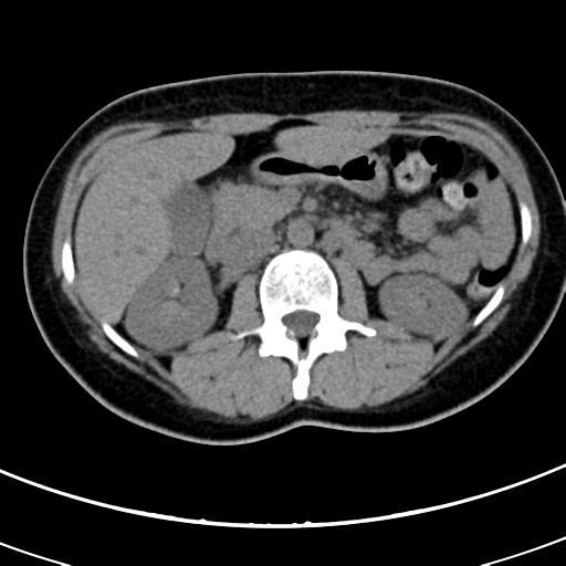 Acute appendicitis (Radiopaedia 30261-30888 Axial non-contrast 25).jpg