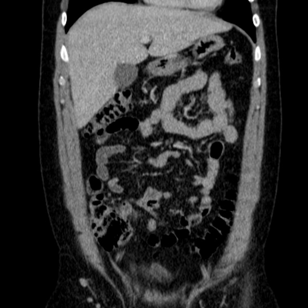 Acute appendicitis (Radiopaedia 38255-40270 Coronal C+ portal venous phase 29).jpg