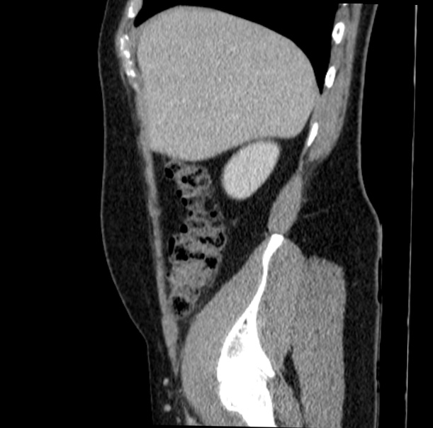 Acute appendicitis (Radiopaedia 38255-40270 Sagittal C+ portal venous phase 19).jpg