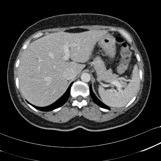 Acute appendicitis (Radiopaedia 48792-53822 Axial C+ portal venous phase 23).jpg