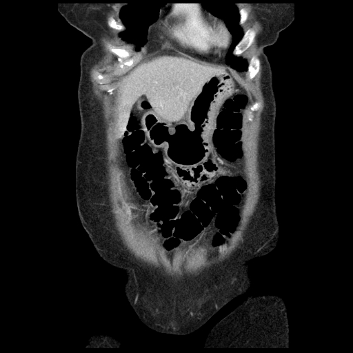 Acute appendicitis (Radiopaedia 52672-58589 Coronal C+ portal venous phase 2).jpg