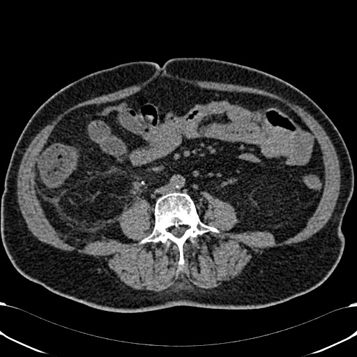 Acute appendicitis (Radiopaedia 58627-65818 Axial non-contrast 51).jpg