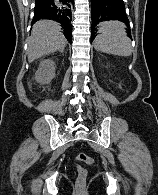 Acute appendicitis (Radiopaedia 58627-65818 Coronal non-contrast 52).jpg