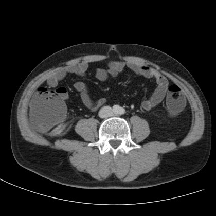 Acute appendicitis (Radiopaedia 66513-75790 Axial C+ portal venous phase 49).jpg