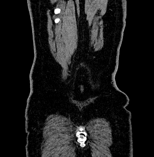 Acute appendicitis (Radiopaedia 79950-93224 Coronal C+ portal venous phase 94).jpg