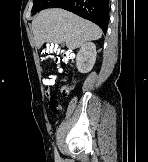 File:Acute appendicitis (Radiopaedia 84780-100240 Sagittal C+ portal venous phase 26).jpg