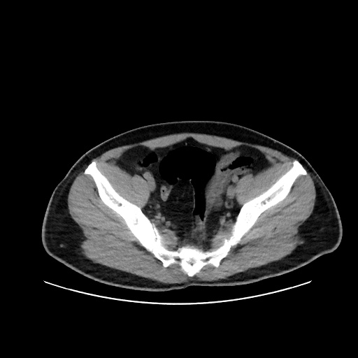 File:Acute appendicitis and COVID 19 pneumonia (Radiopaedia 76604-88380 Axial non-contrast 106).jpg