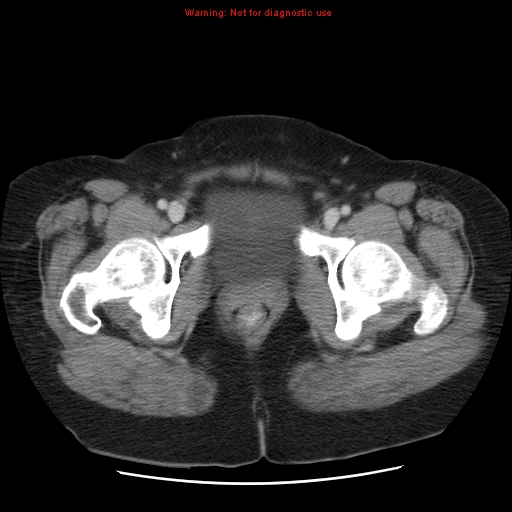 Acute appendicitis complicated by ovarian vein thrombophlebitis (Radiopaedia 16172-15851 Axial C+ portal venous phase 85).jpg