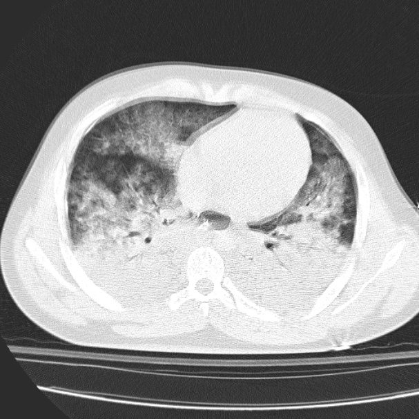 Acute aspiration pneumonitis (Radiopaedia 33605-34703 Axial lung window 62).jpg