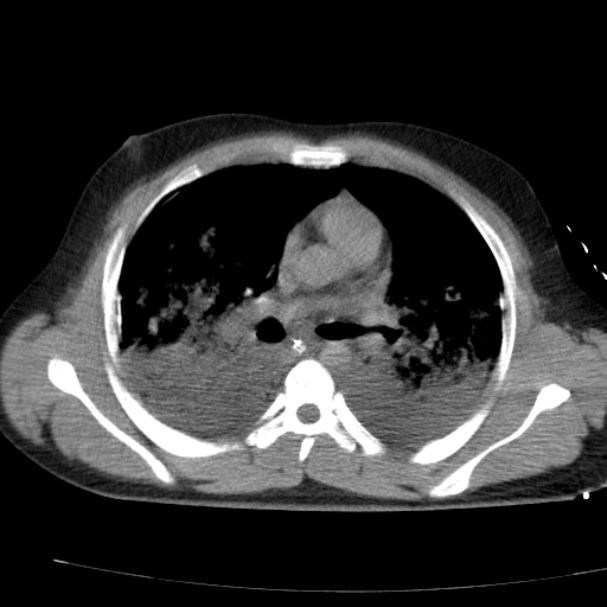 Acute aspiration pneumonitis (Radiopaedia 33605-34703 Axial non-contrast 44).jpg