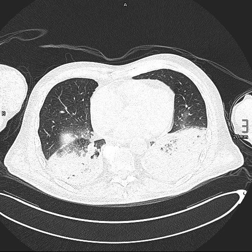 File:Acute aspiration pneumonitis (Radiopaedia 55642-62166 Axial lung window 105).jpg